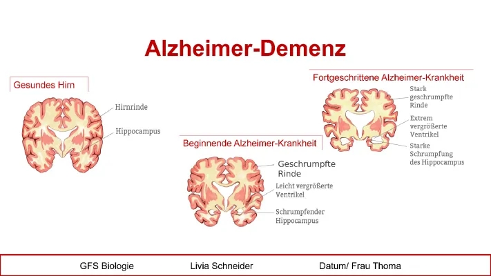 Alzheimer und Demenz Symptome und Ursachen - Neueste Therapien und Behandlung