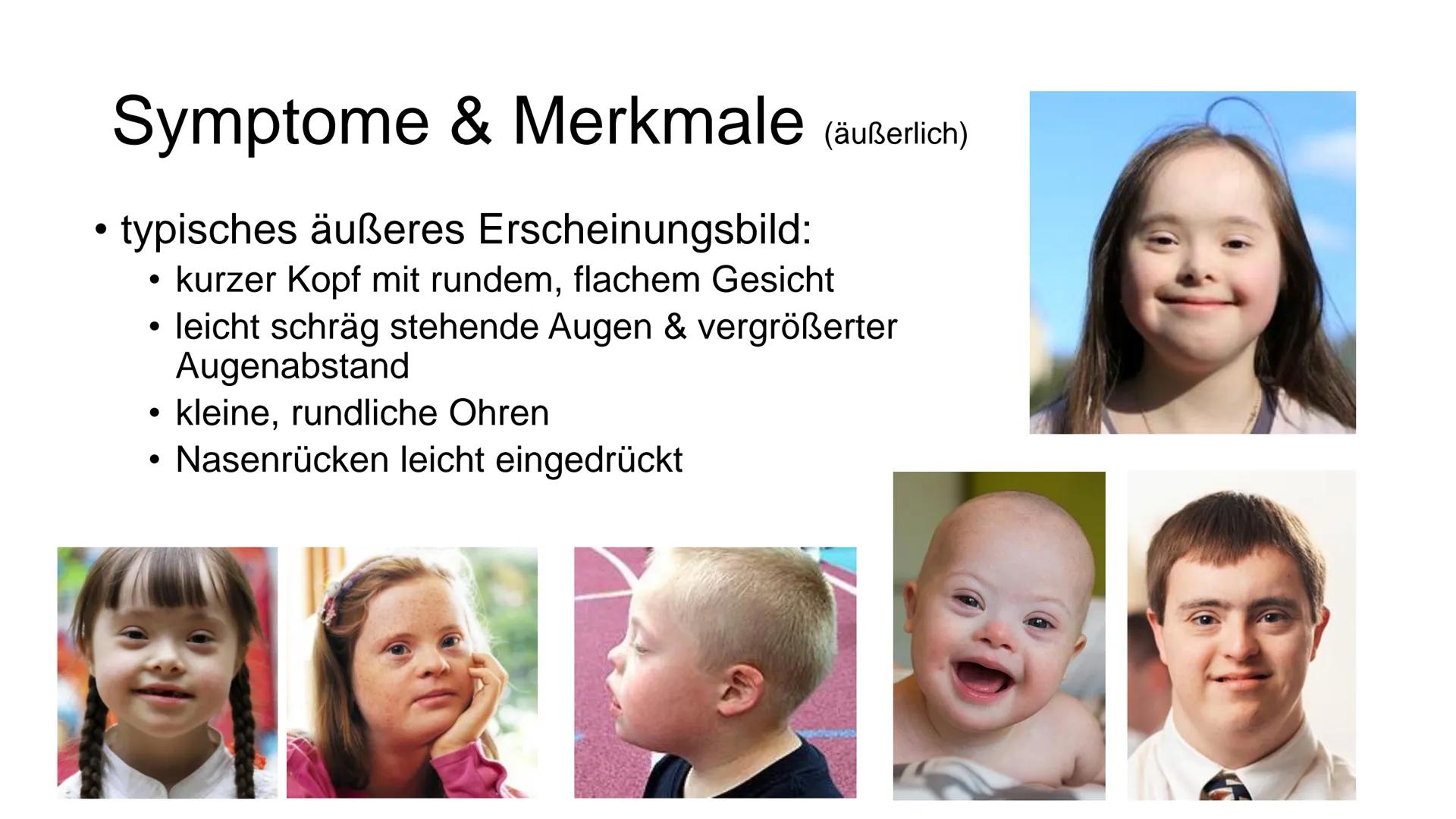 I
Was ist Trisomie 21?
angeborene Anomalie (=Abweichung) des Erbguts →→Genommutation, bei der das 21. Chromosom
dreimal vorhanden ist →→ Bet