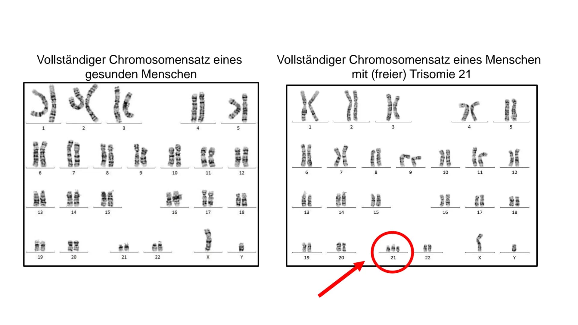 I
Was ist Trisomie 21?
angeborene Anomalie (=Abweichung) des Erbguts →→Genommutation, bei der das 21. Chromosom
dreimal vorhanden ist →→ Bet