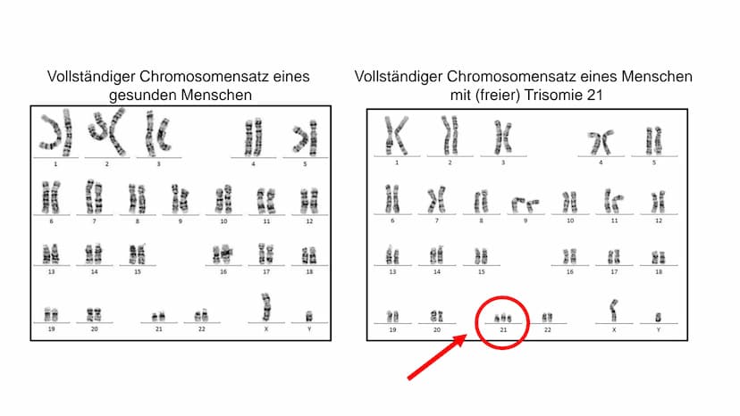 I
Was ist Trisomie 21?
angeborene Anomalie (=Abweichung) des Erbguts →→Genommutation, bei der das 21. Chromosom
dreimal vorhanden ist →→ Bet