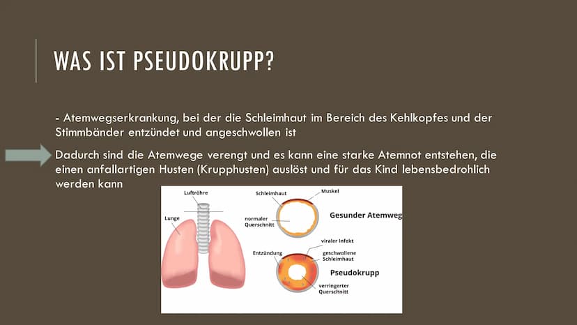 Pseudokrupp (Stenosierende Laryngitis)
Was ist Pseudokrupp?
Atemwegserkrankung, bei der die Schleimhaut im Bereich des Kehlkopfes und der
St