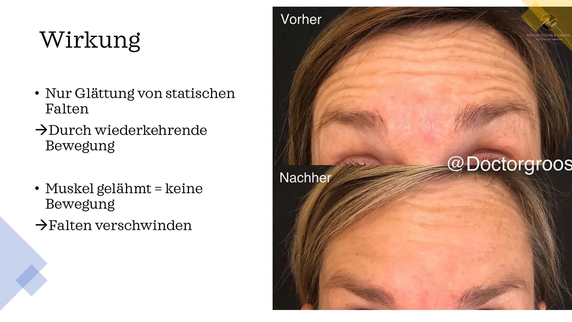 Botox
vom Gift zur
Faltenspritze Gliederung
Wirkstoff
Fallbeispiel
Geschichte
Wirkung
Verwendung &
Nutzen
Fun Facts BOTOX
0.9
10
ml
9.8
0.6
