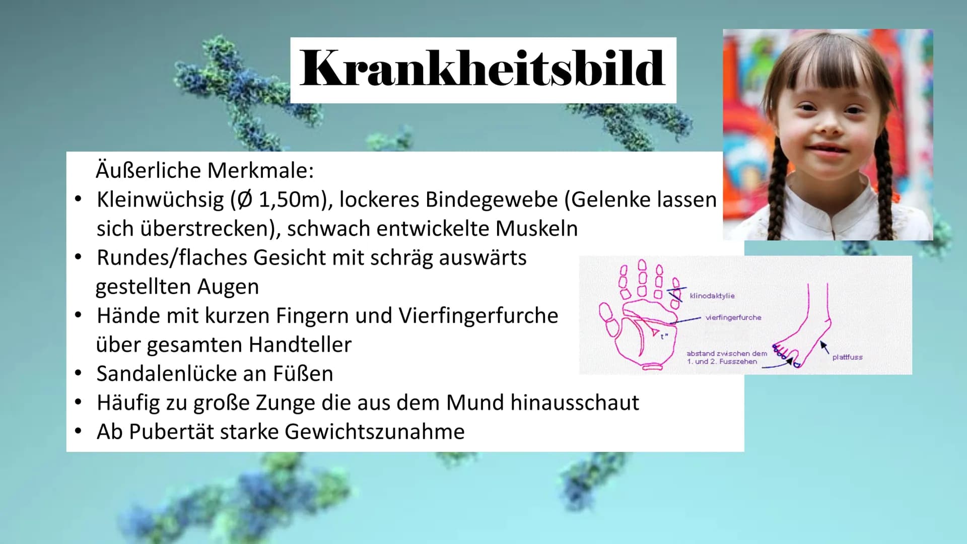 Trisomie 21
ہو Allgemeine Infos
Gliederung
Krankheitsbild
Häufigkeit in
der
Bevölkerung
Art der
Mutation
Therapie Allgemeine Infos
• Viele v