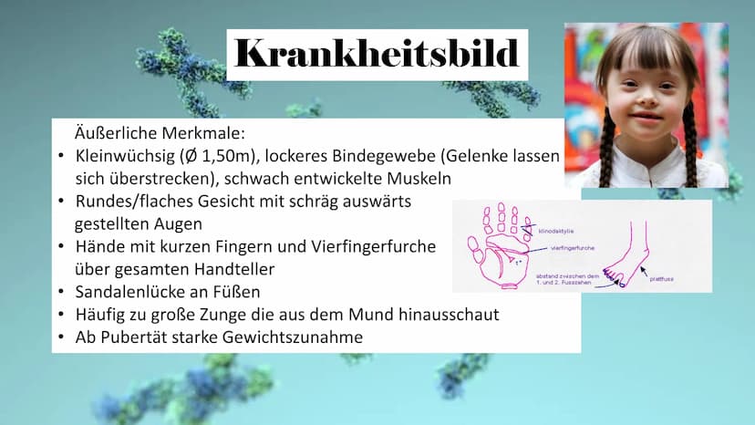 Trisomie 21
ہو Allgemeine Infos
Gliederung
Krankheitsbild
Häufigkeit in
der
Bevölkerung
Art der
Mutation
Therapie Allgemeine Infos
• Viele v