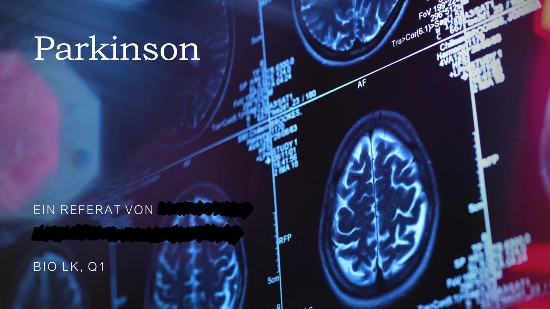 Parkinson
EIN REFERAT VON
BIO LK, Q1
23/180
OKES
LOX
2008 63
STUDY1
B91191
16.11.56
2 MA 18
RFP
5cm
AF
33
296 512
BASSA
667
FOV 199
Tra>Cor(