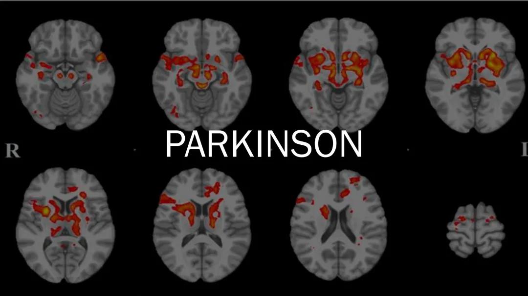 Parkinson