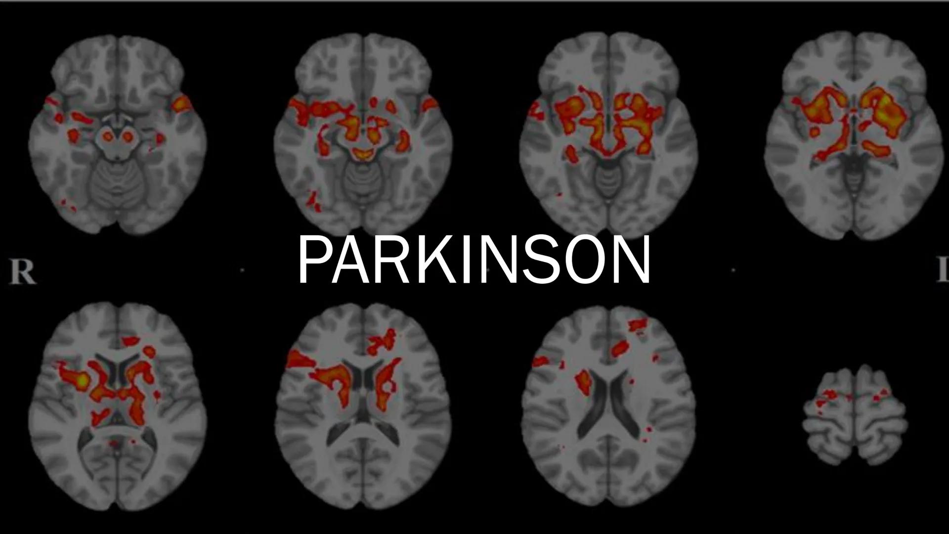 PARKINSON

R

L # Aufbau meines Vortrages

- Was ist Parkinson überhaupt?
- Entdeckung
- Ursachen
- ■ Krankheitsbild
- Häufigkeit
- ■ Diagno