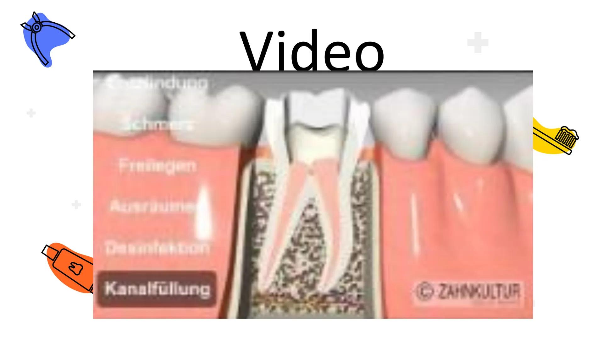 W
Pulpitis
Iva Georgievska M
1.
2.
3.
Was ist
Pulpitis?
Ursachen
Gliederung
Diagnostik
4. Symptome
5. Therapie + Was ist
Pulpitis?
Unter der
