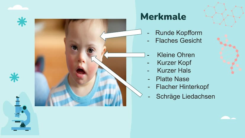 Down-Syndrom
!!!!!
PA Gliederung
- Was ist Trisomie 21?
-
Entdeckung
- Ursache
- Enstehung
- Körperliche Auffälligkeiten
- Behandlung
- Vork