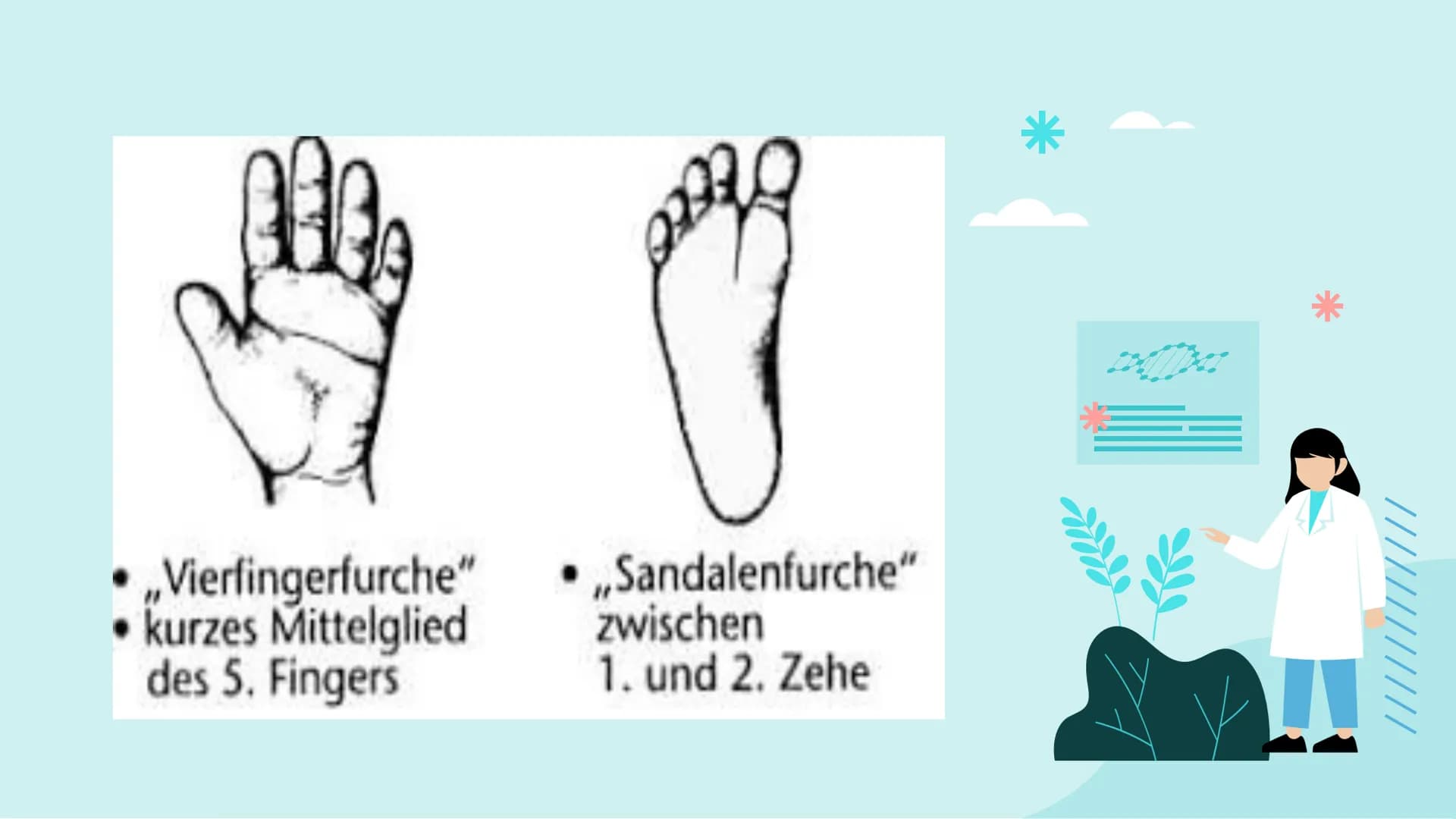 Down-Syndrom
!!!!!
PA Gliederung
- Was ist Trisomie 21?
-
Entdeckung
- Ursache
- Enstehung
- Körperliche Auffälligkeiten
- Behandlung
- Vork