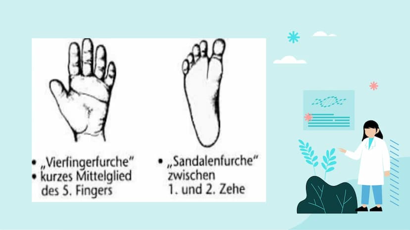 Down-Syndrom
!!!!!
PA Gliederung
- Was ist Trisomie 21?
-
Entdeckung
- Ursache
- Enstehung
- Körperliche Auffälligkeiten
- Behandlung
- Vork