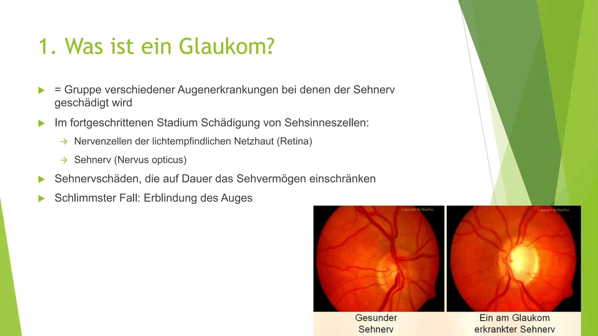 Der grüne Star
(Glaukom) Gliederung
1. Was ist ein Glaukom
2. Symptome
3. Arten von Glaukomen
4. Entstehung
5. Behandlung
6. Quellen
Geschäd