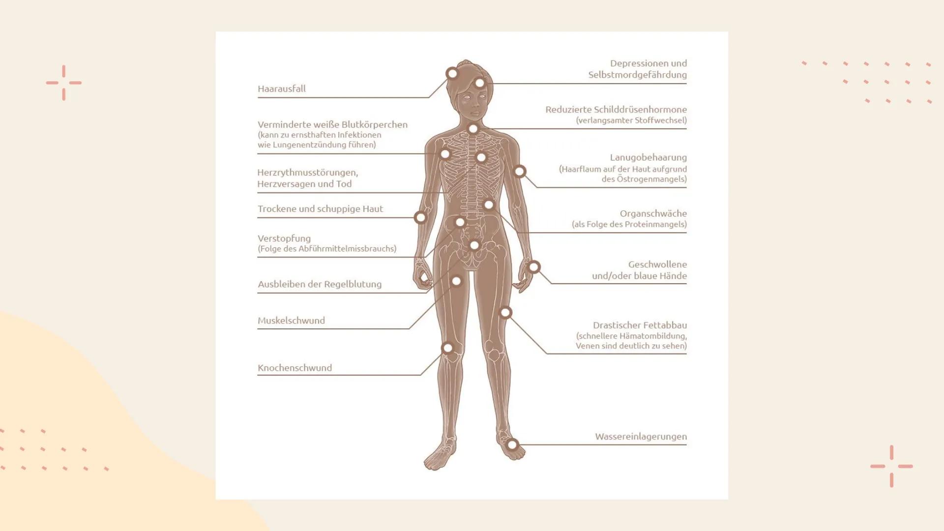 Anorexie
Auf Social Media
+- 1-
01
Anorexia nervosa
04
Wer ist Ana?
Gliederung
02
Die Rolle der
Sozialen Medien
05
Quellen
03
Folgen der
Ein