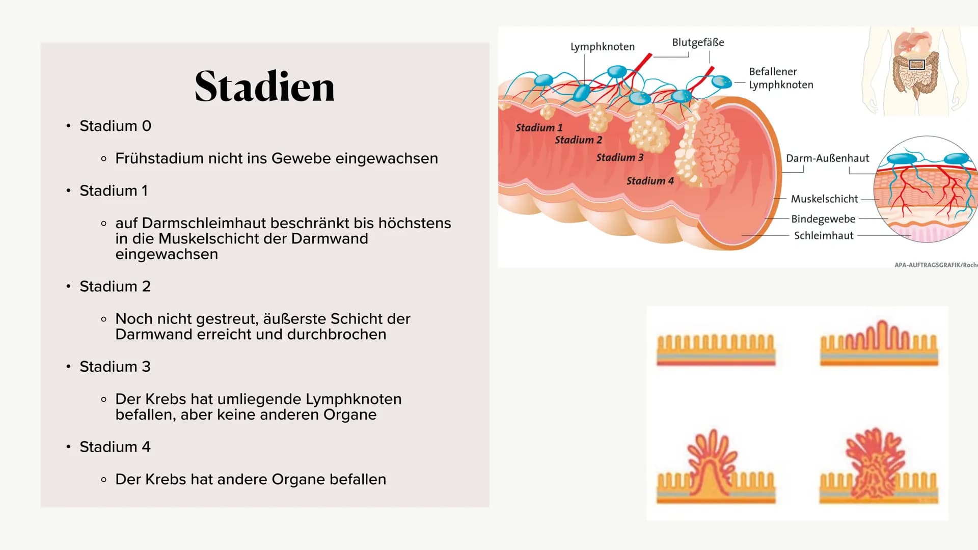 Krankheitsbild (Dick-)Darmkrebs
und die Vorsorgeuntersuchung
(Rektoskopie / Koloskopie)
Alina Hach 30.04.2020 (Dick-)
Darmkrebs
Kolorektales