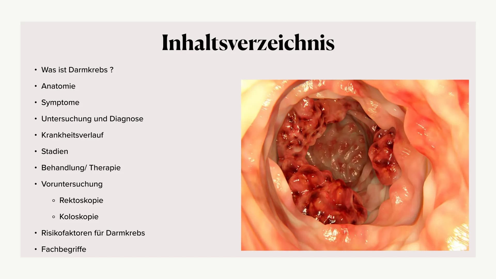 Krankheitsbild (Dick-)Darmkrebs
und die Vorsorgeuntersuchung
(Rektoskopie / Koloskopie)
Alina Hach 30.04.2020 (Dick-)
Darmkrebs
Kolorektales