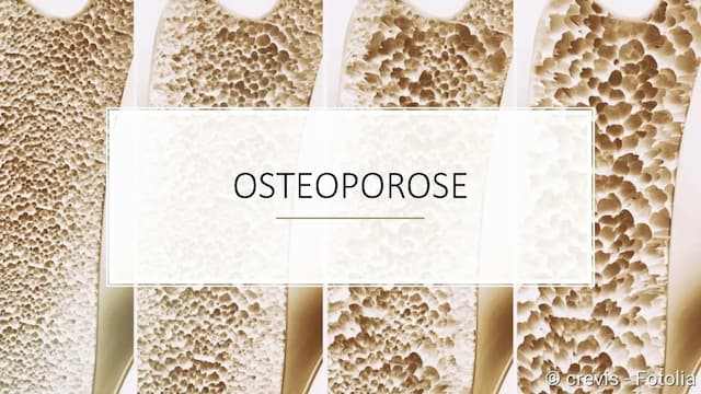 Know Osteoporose Vortrag thumbnail