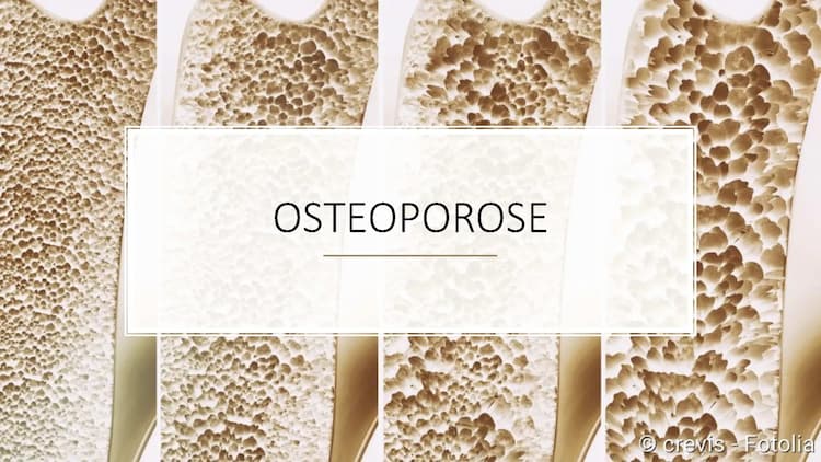 Know Osteoporose Vortrag thumbnail