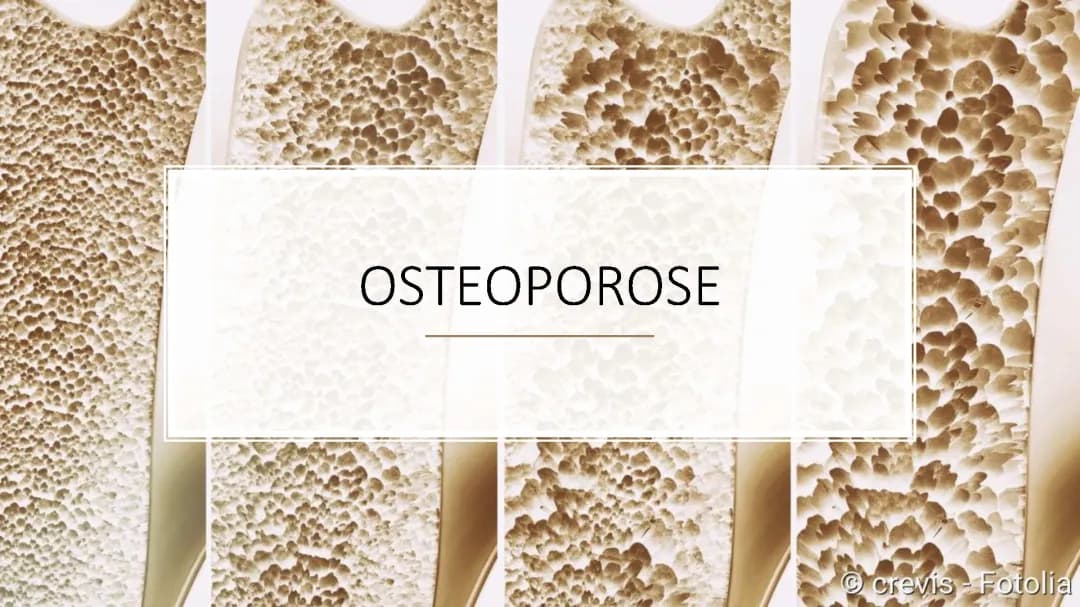 Osteoporose Vortrag