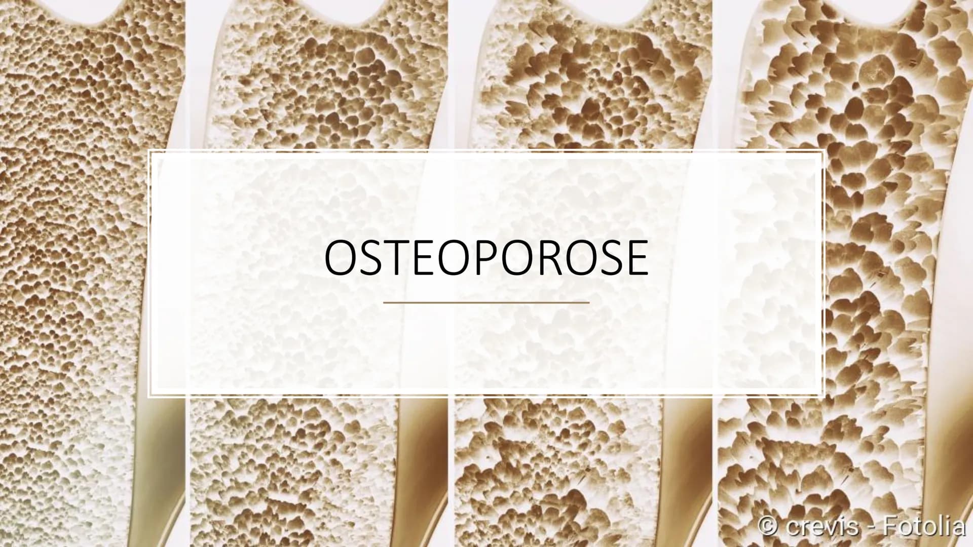 OSTEOPOROSE
crevis- Fotolia INHALTSVERZEICHNIS
• Definition
• Wer ist betroffen?
Symptome
• Die Knochen - Übersicht
●
• Die Knochensubstanz
