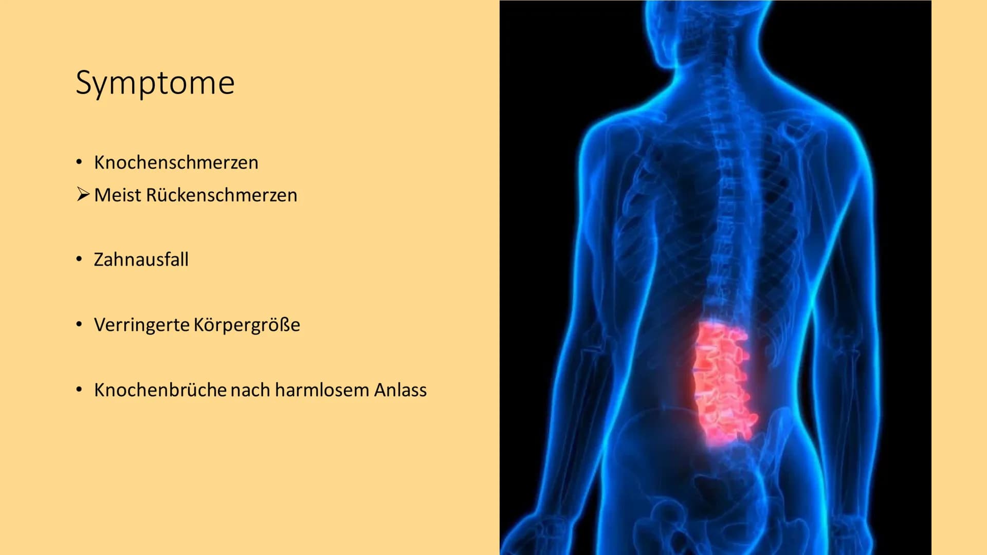 OSTEOPOROSE
crevis- Fotolia INHALTSVERZEICHNIS
• Definition
• Wer ist betroffen?
Symptome
• Die Knochen - Übersicht
●
• Die Knochensubstanz
