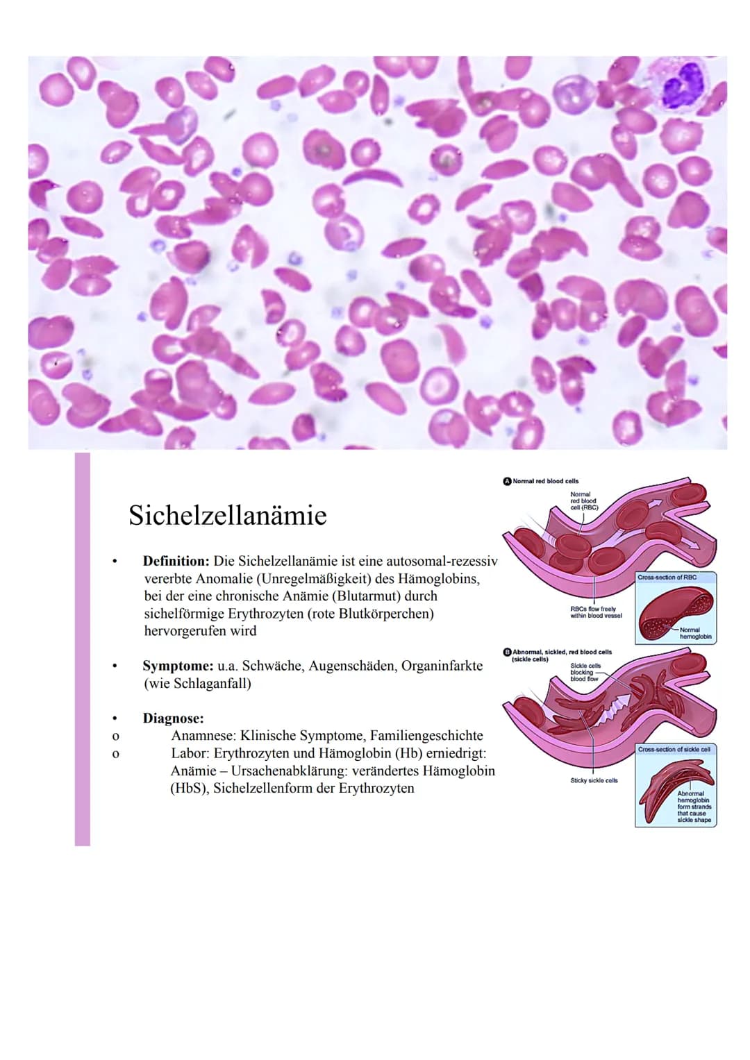 0
O
Sichelzellanämie
Definition: Die Sichelzellanämie ist eine autosomal-rezessiv
vererbte Anomalie (Unregelmäßigkeit) des Hämoglobins,
bei 