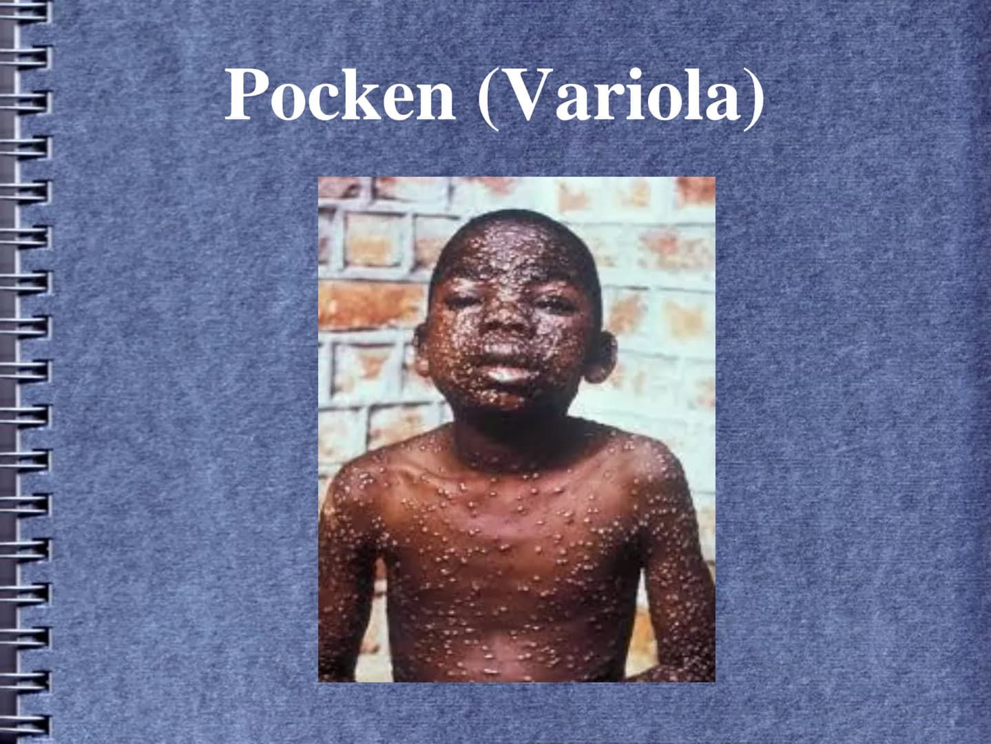 Pocken (Variola) Historischer Hintergrund
Erreger
Gliederung
Verbreitungsgebiet
Infektionsweg
Inkubationszeit
Symptome
Krankheitsverlauf
Geg