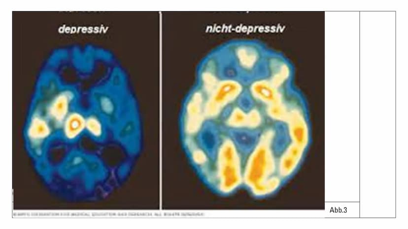 Eva Gedig, Sophia Pipew
05.05.2022
Depressionen und die
Wirkung von
Antidepressiva
Abb.1 Gliederung
1 Depressionen
Allgemeines
Ursachen
Symp