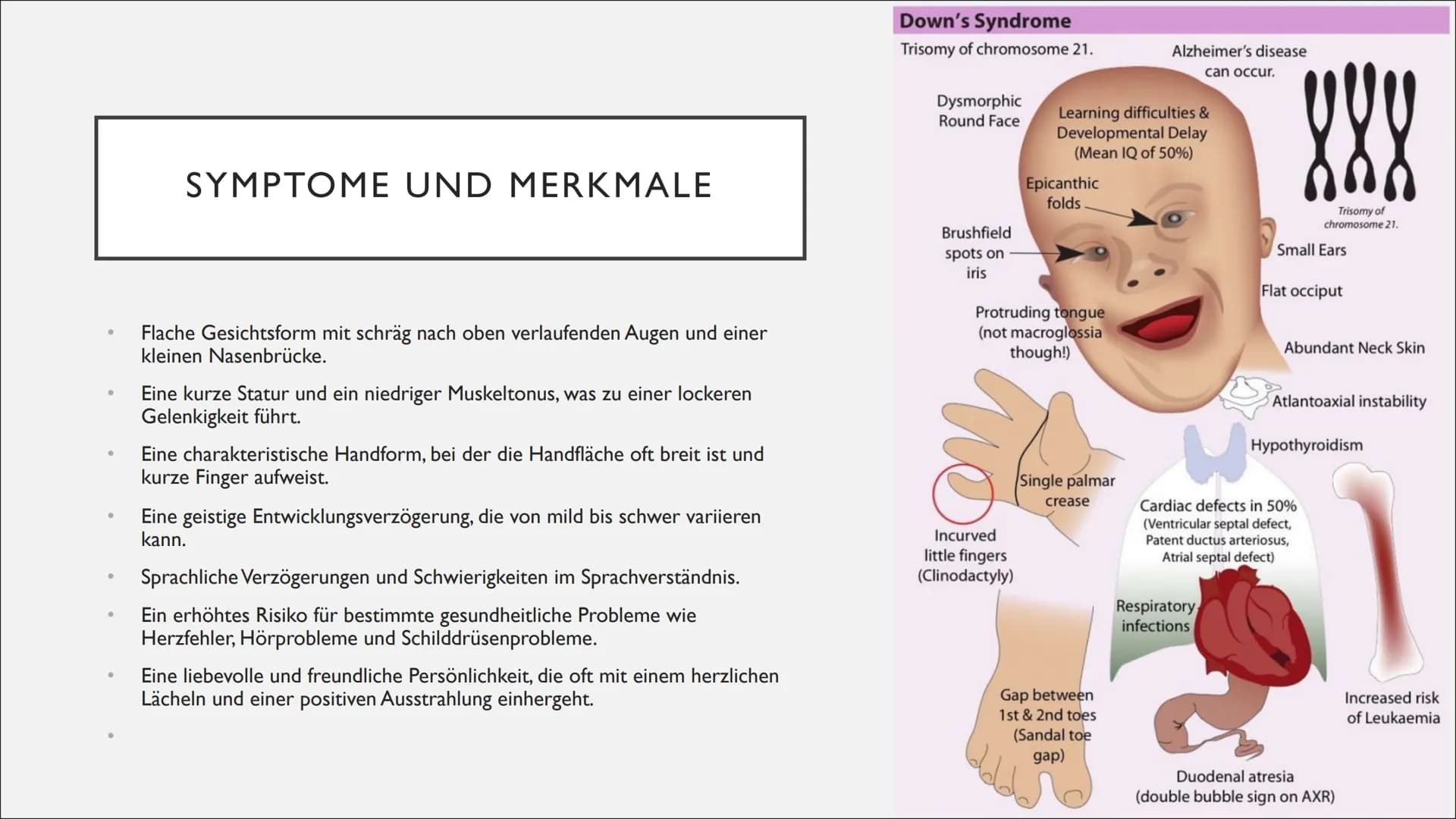DOWN SYNDROM GLIEDERUNG
Was ist das down-syndrom?
Ursachen und diagnose
Symptome und merkmale
Therapie
Herausforderungen und Chancen
• Fakte