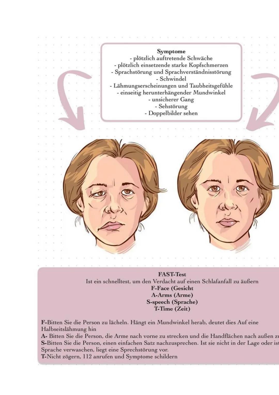 # Apoplex

Definition Schlaganfall (Apoplex) bezeichnet die plötzlich auftretende Unterversorgung des
Gehirns mit Sauerstoff. Diese führen z