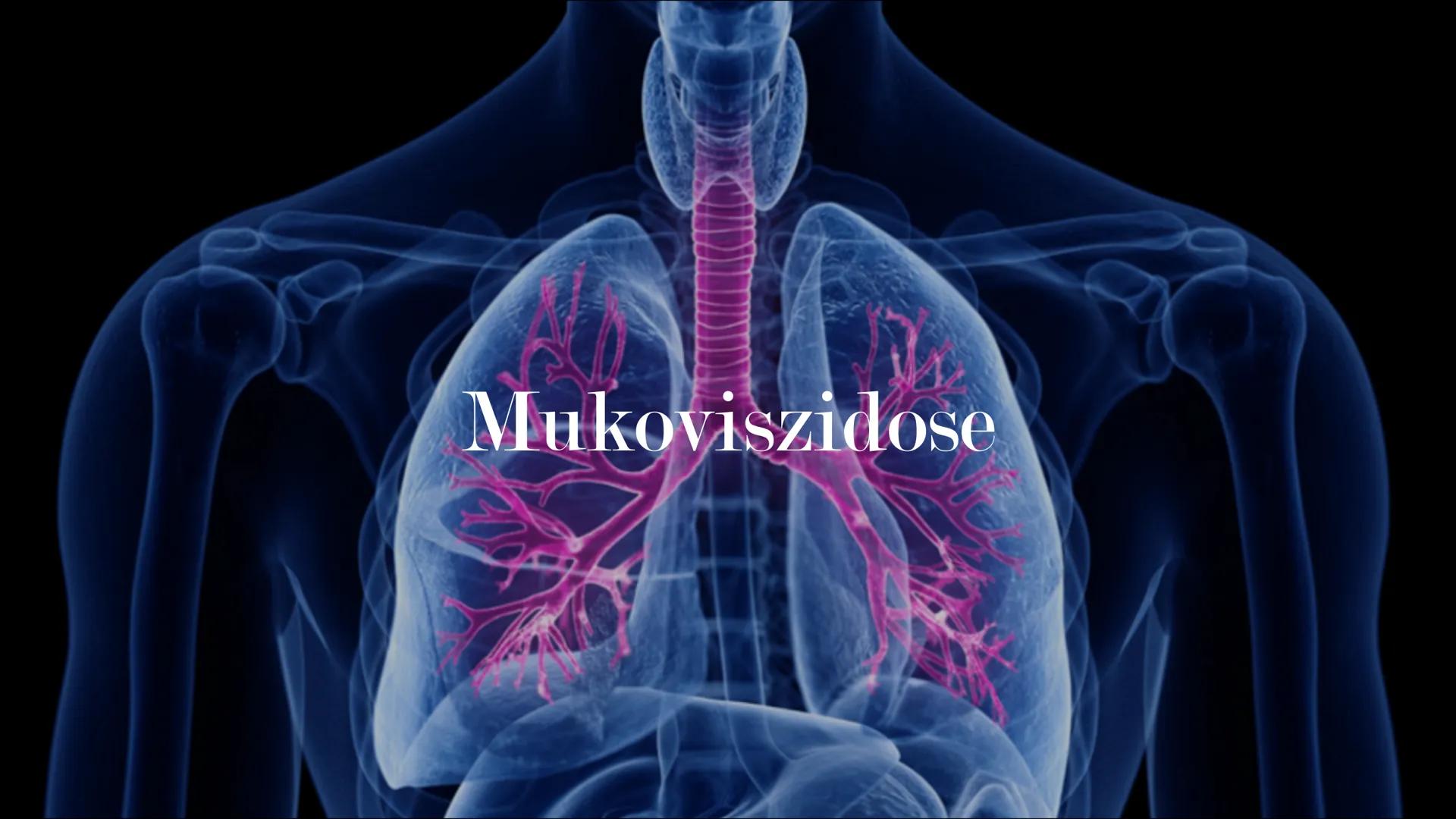 Mukoviszidose # Inhalt

• Was ist Mukoviszidose?
• Ursachen
• Genetische Vererbung
• Symptome
• Diagnoseverfahren
• Behandlungsmöglichkeiten