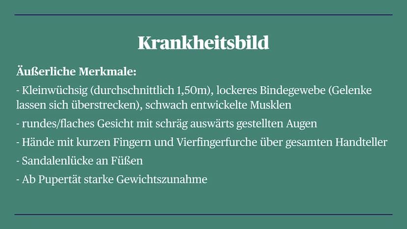 Trisomie 21
Down-Syndrom
Zoe, Louisa, Alina, Linda, La Toya, Talida, Emma, Diana Gliederung
- Definition
- Krankheitsbild
- Entstehung der F