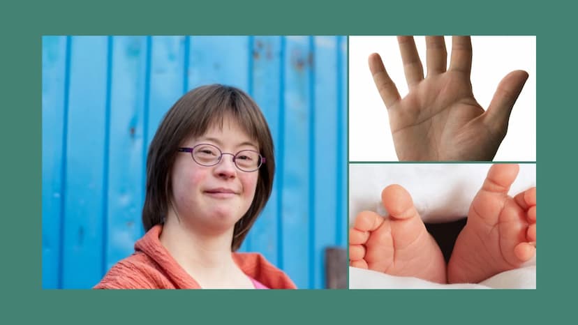 Trisomie 21
Down-Syndrom
Zoe, Louisa, Alina, Linda, La Toya, Talida, Emma, Diana Gliederung
- Definition
- Krankheitsbild
- Entstehung der F