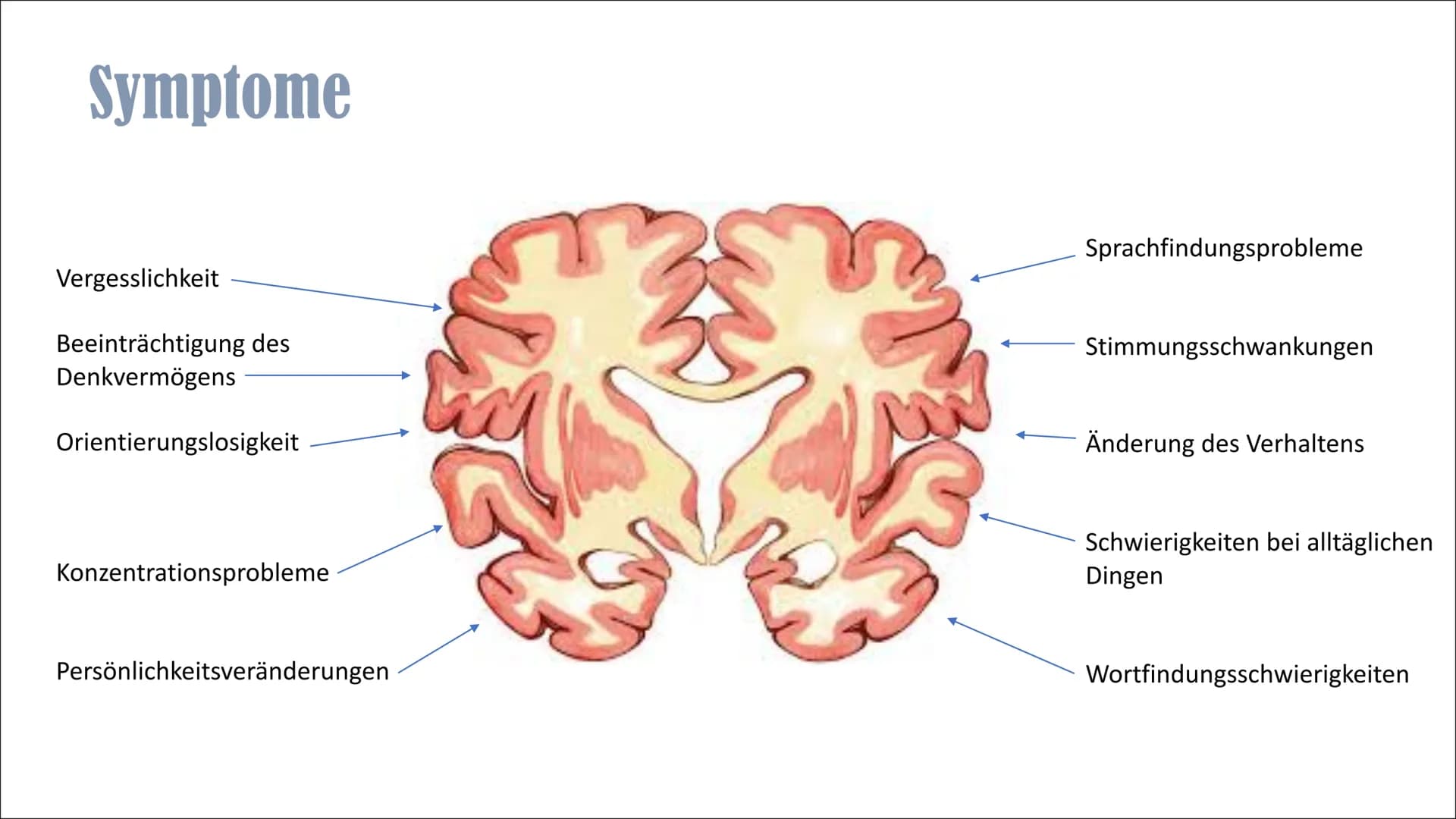 Alzheimer
Von Lina Inhaltsverzeichnis
▪ Was ist Demenz?
▪ Statistik Demenz
▪ Was ist Alzheimer?
- Geschichte Alzheimer
- Einführung
▪ Sympto