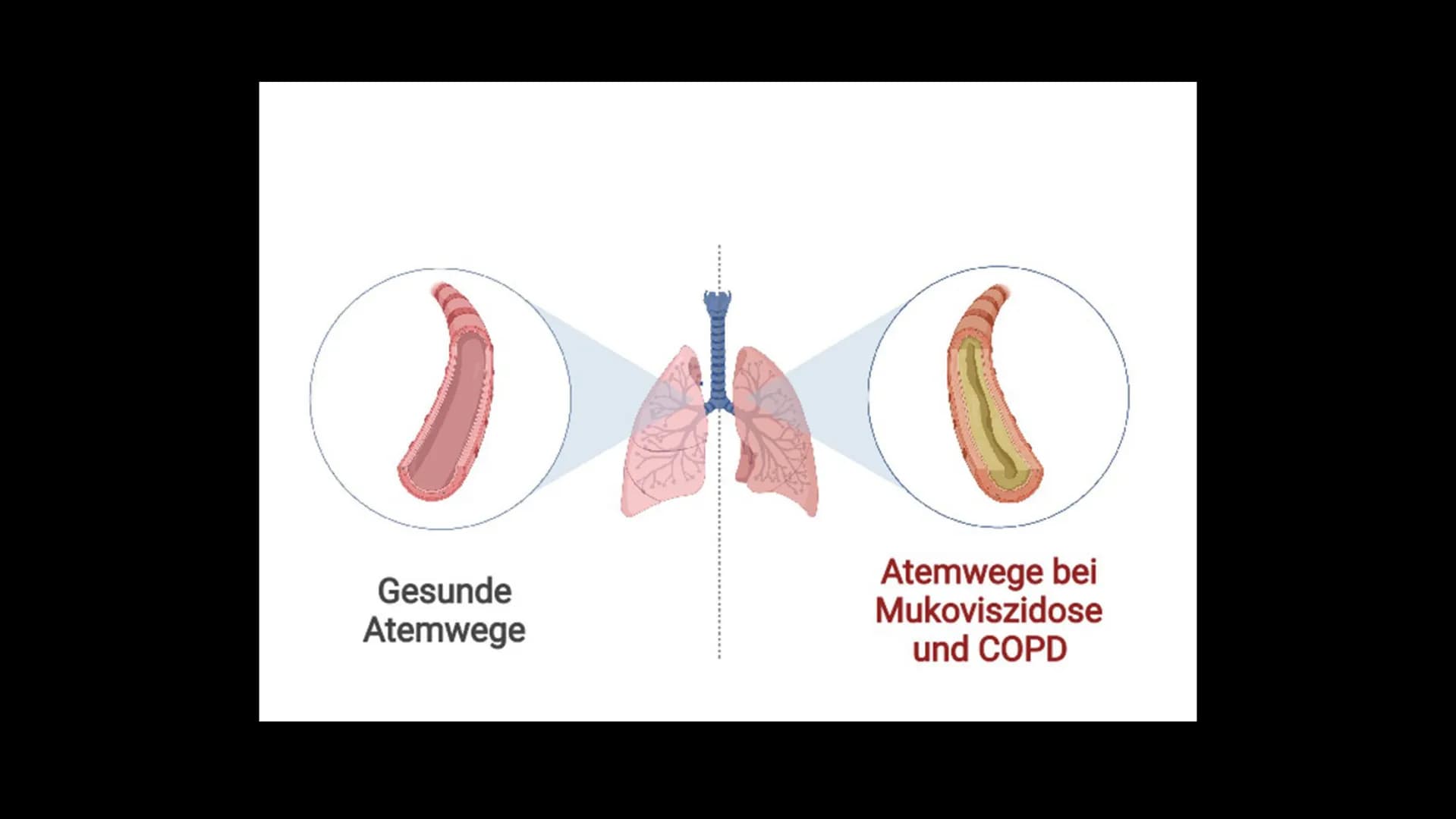 Mukoviszidose Gliederung
• Was ist Mukoviszidose?
Symptome
genetische Ursachen
Zusammenhang
› Vererbungsmuster
Häufigkeit
• Leben mit Mukovi