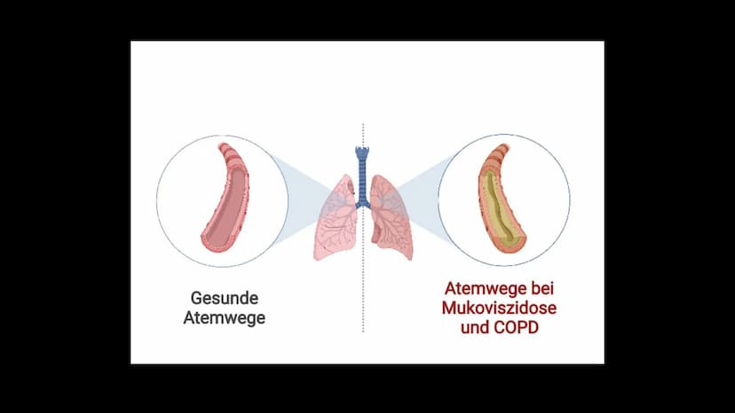 Mukoviszidose Gliederung
• Was ist Mukoviszidose?
Symptome
genetische Ursachen
Zusammenhang
› Vererbungsmuster
Häufigkeit
• Leben mit Mukovi