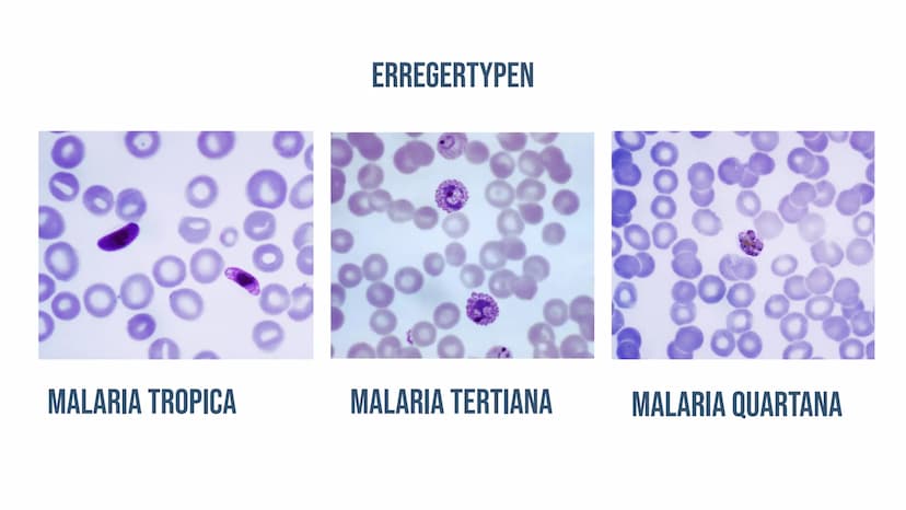 MALARIA
Von Lisa Reichert und Emma Schäfer 01
ALLGEMEINE INFORMATIONEN
Zahlen
Erregertypen
04
VORKOMMEN
Anzahl
geographisch
INHALT
02
KRANKH