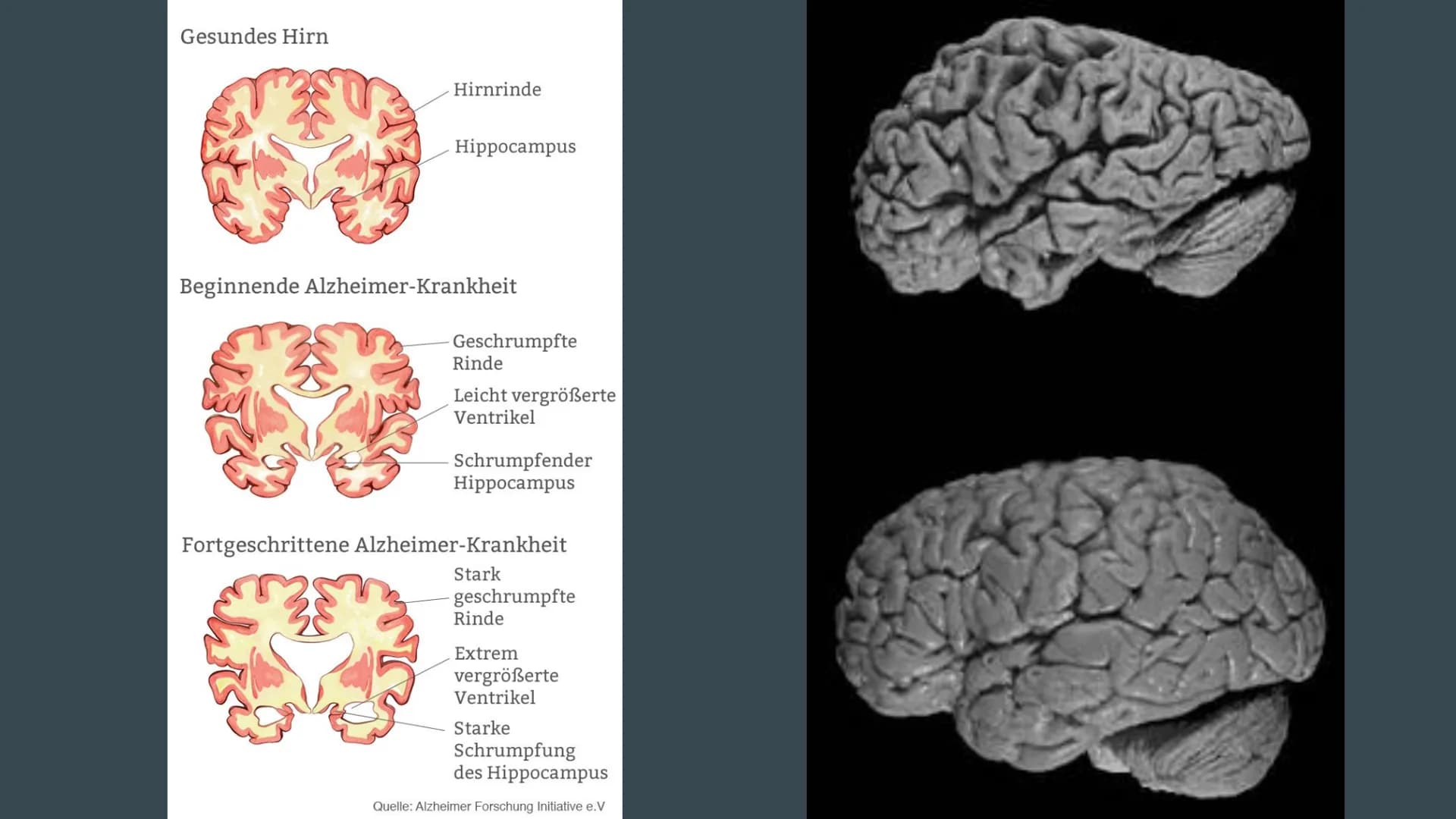 Alzheimer
Präsentation von Dennisa Dobrila
Grundkurs Biologie Gliederung
1. Alzheimer Forschung Initiative e.V.
2. Was ist Alzheimer?
3.
Ges