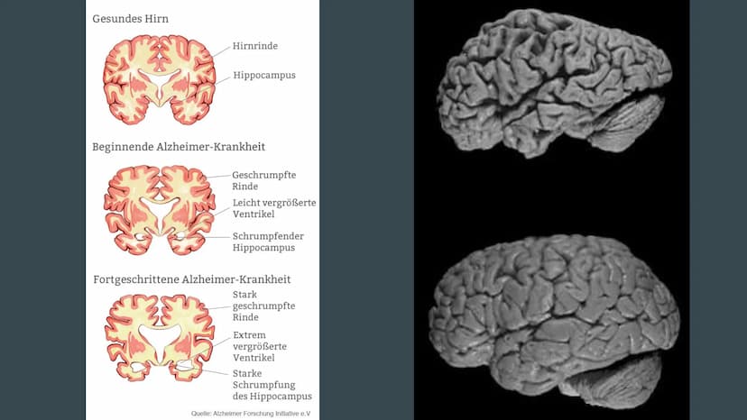 Alzheimer
Präsentation von Dennisa Dobrila
Grundkurs Biologie Gliederung
1. Alzheimer Forschung Initiative e.V.
2. Was ist Alzheimer?
3.
Ges