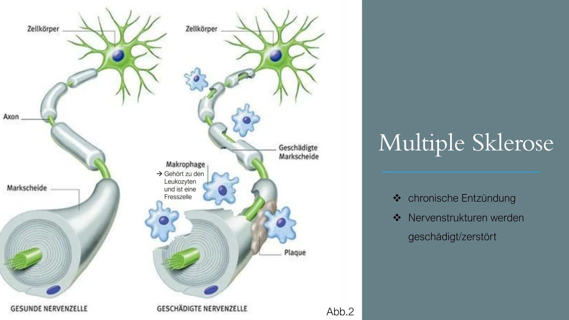 https://gesundpedia.de/images/ZNS.jpg Abb. 1
Multiple
Sklerose
„EINE KRANKHEIT MIT TAUSEND
NERGIS
GESICHTERN"
; S4; NEUROBIOLOGIE; PGS GLIED