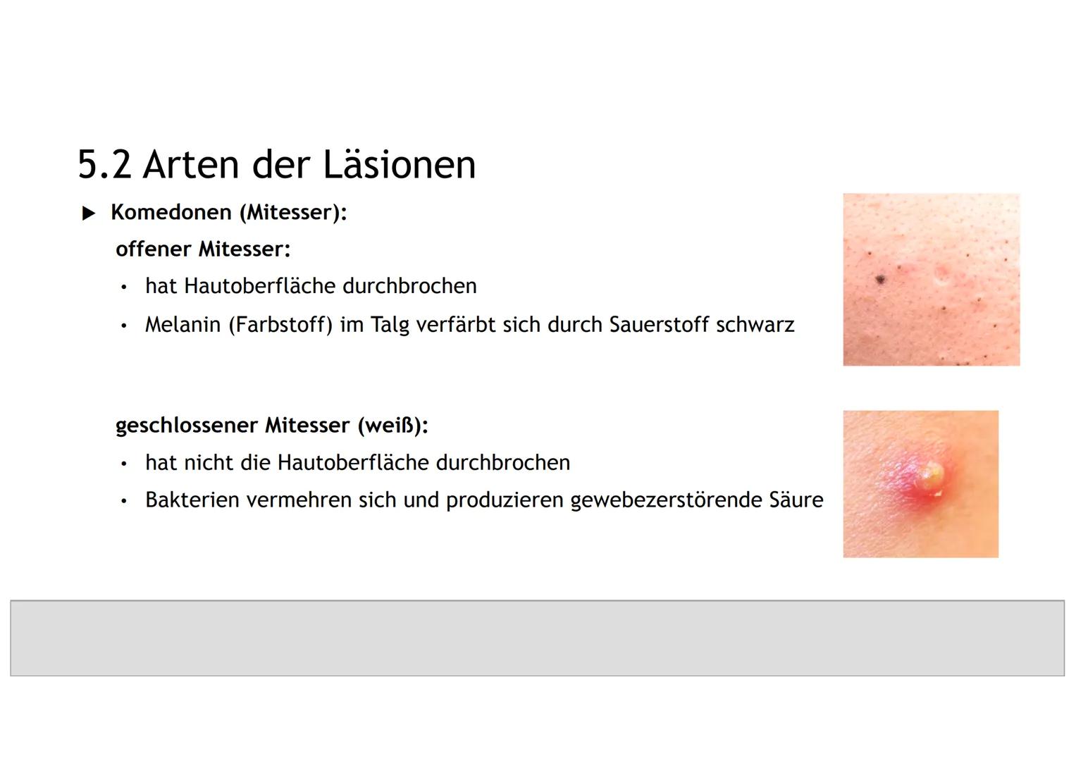 AKNE DIE GLIEDERUNG
1. DER EINSTIEG
2. GENERELLE INFORMATIONEN ZU AKNE
3.
4. DIE HAUT
5. DIE ENTSTEHUNG UND ARTEN VON LÄSIONEN
6.
DIE URSACH