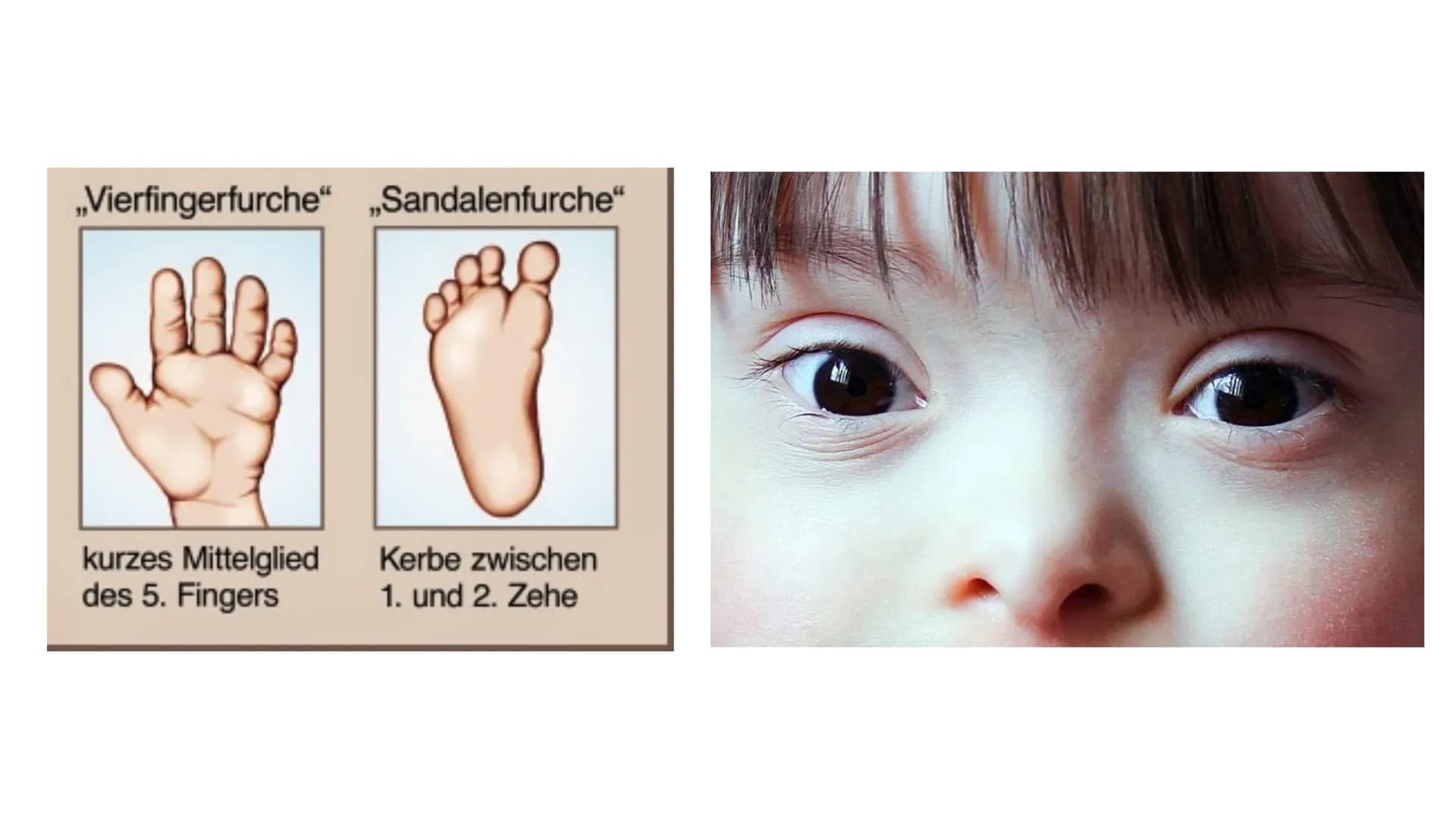 Trisomie 21 Inhaltsverzeichnis
1. Allgemeine Informationen
2. Krankheitsbild
2.1. Äußerliche Merkmale
2.2. Gesundheitliche Folgen
3. Bevölke