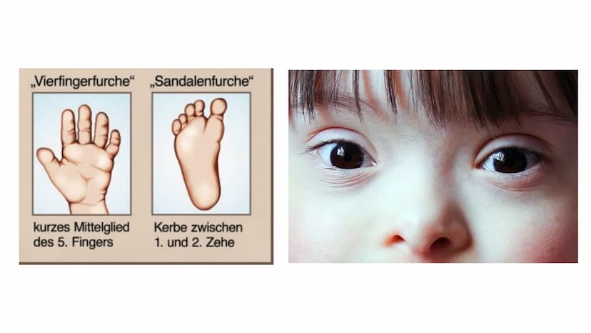 Trisomie 21 Inhaltsverzeichnis
1. Allgemeine Informationen
2. Krankheitsbild
2.1. Äußerliche Merkmale
2.2. Gesundheitliche Folgen
3. Bevölke
