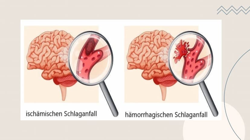 Schlaganfall
Alles rund um den Schlaganfall.
O Gliederung
1
3
Definition
Apoplex - Hirnsult
Behandlung - Prävention
Therapien, Rehabilitatio