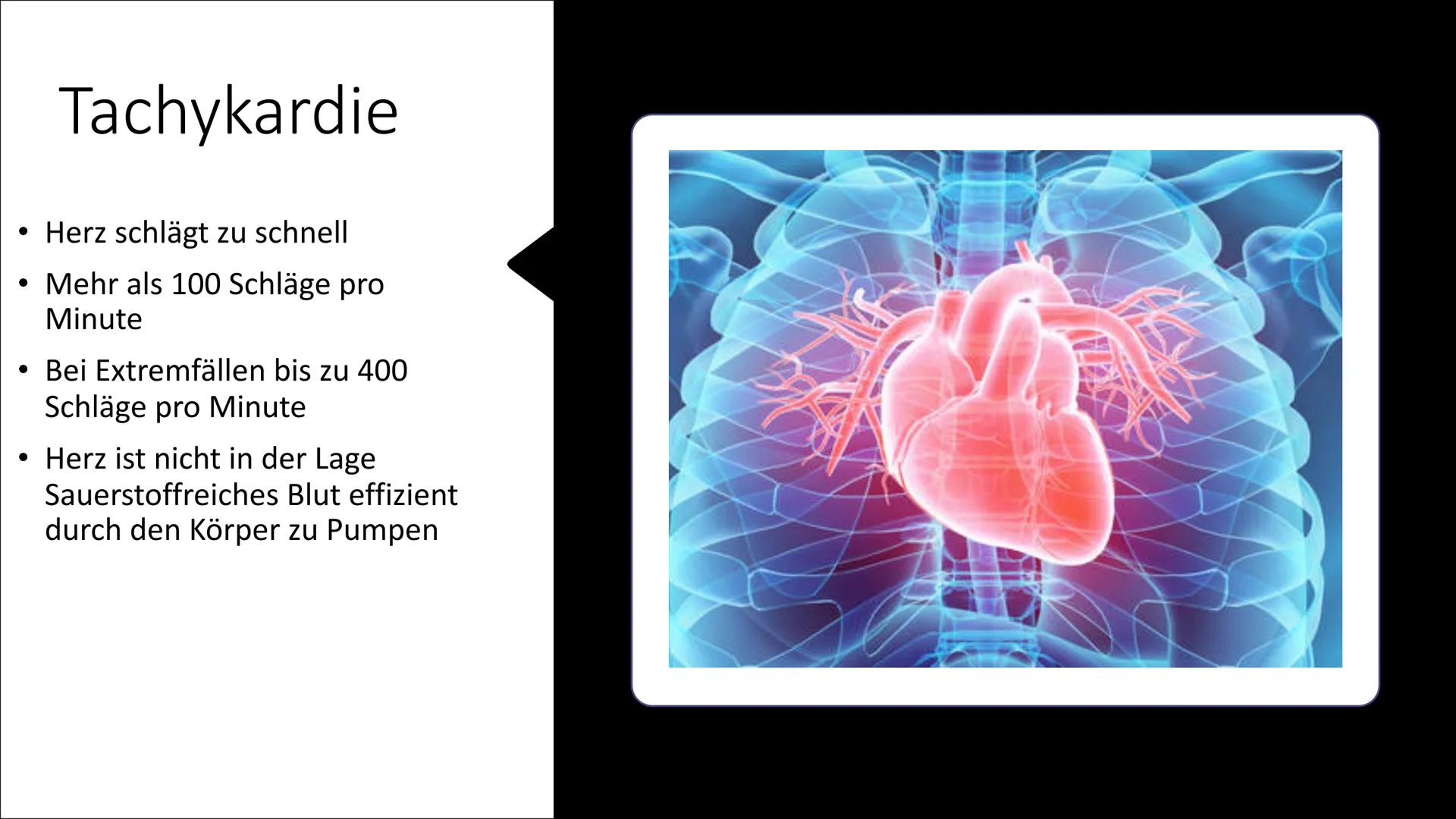 ܐܐܐܐܐܐܝܝܐܝܝܐܝܝܐ
Л
Herzrhythmusstörungen Inhaltsverzeichnis
• Definition
• Arten von
Herzrhythmusstörungen
●
Entstehung
Risikofaktoren
• Mögl