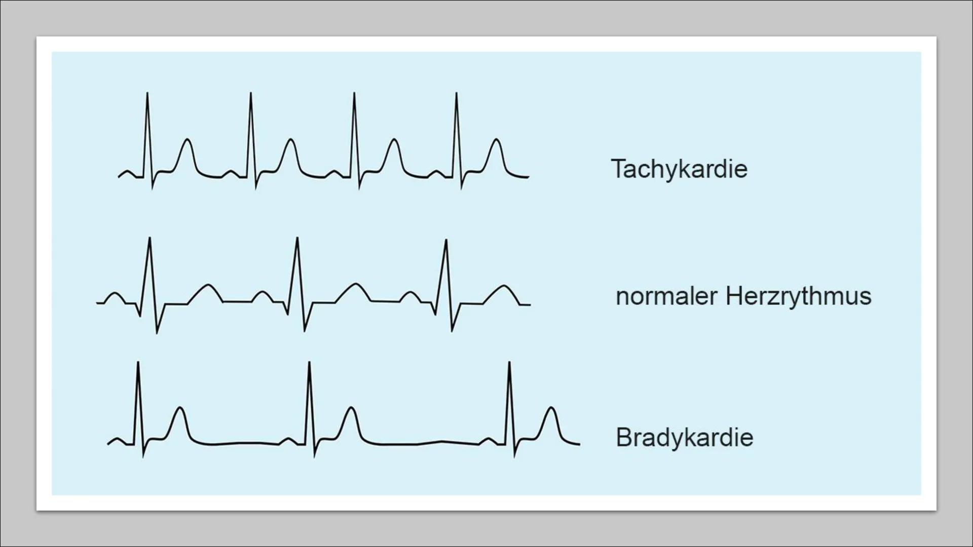 ܐܐܐܐܐܐܝܝܐܝܝܐܝܝܐ
Л
Herzrhythmusstörungen Inhaltsverzeichnis
• Definition
• Arten von
Herzrhythmusstörungen
●
Entstehung
Risikofaktoren
• Mögl