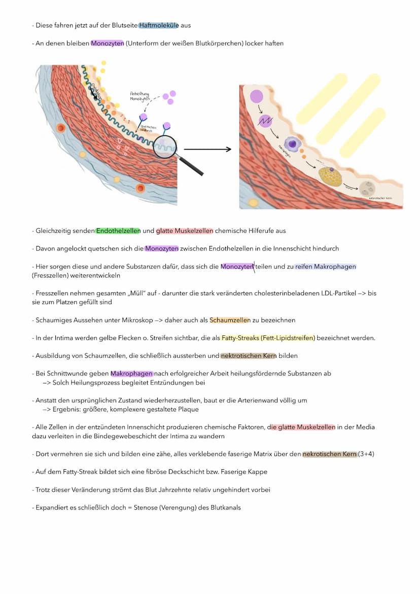 P1 ABITUR
Apoplex
PATHOGENESE DES SCHLAGANFALLS
I. TRANSITORISCH ISCHÄMISCHE ATTACKE (TIA)
TIA, eine Vorstufe des Schlaganfalls. Es kommt zu