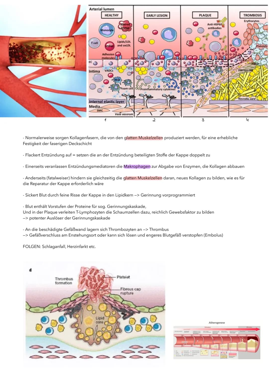 P1 ABITUR
Apoplex
PATHOGENESE DES SCHLAGANFALLS
I. TRANSITORISCH ISCHÄMISCHE ATTACKE (TIA)
TIA, eine Vorstufe des Schlaganfalls. Es kommt zu
