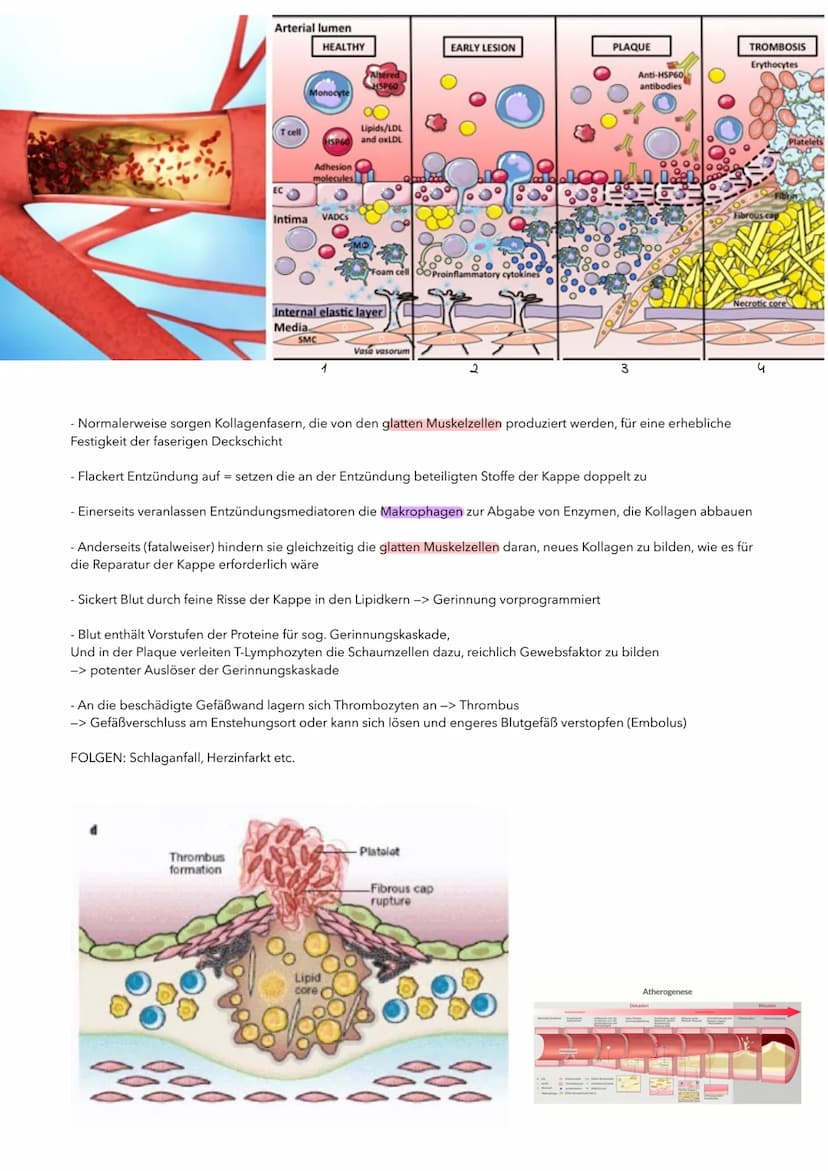 P1 ABITUR
Apoplex
PATHOGENESE DES SCHLAGANFALLS
I. TRANSITORISCH ISCHÄMISCHE ATTACKE (TIA)
TIA, eine Vorstufe des Schlaganfalls. Es kommt zu