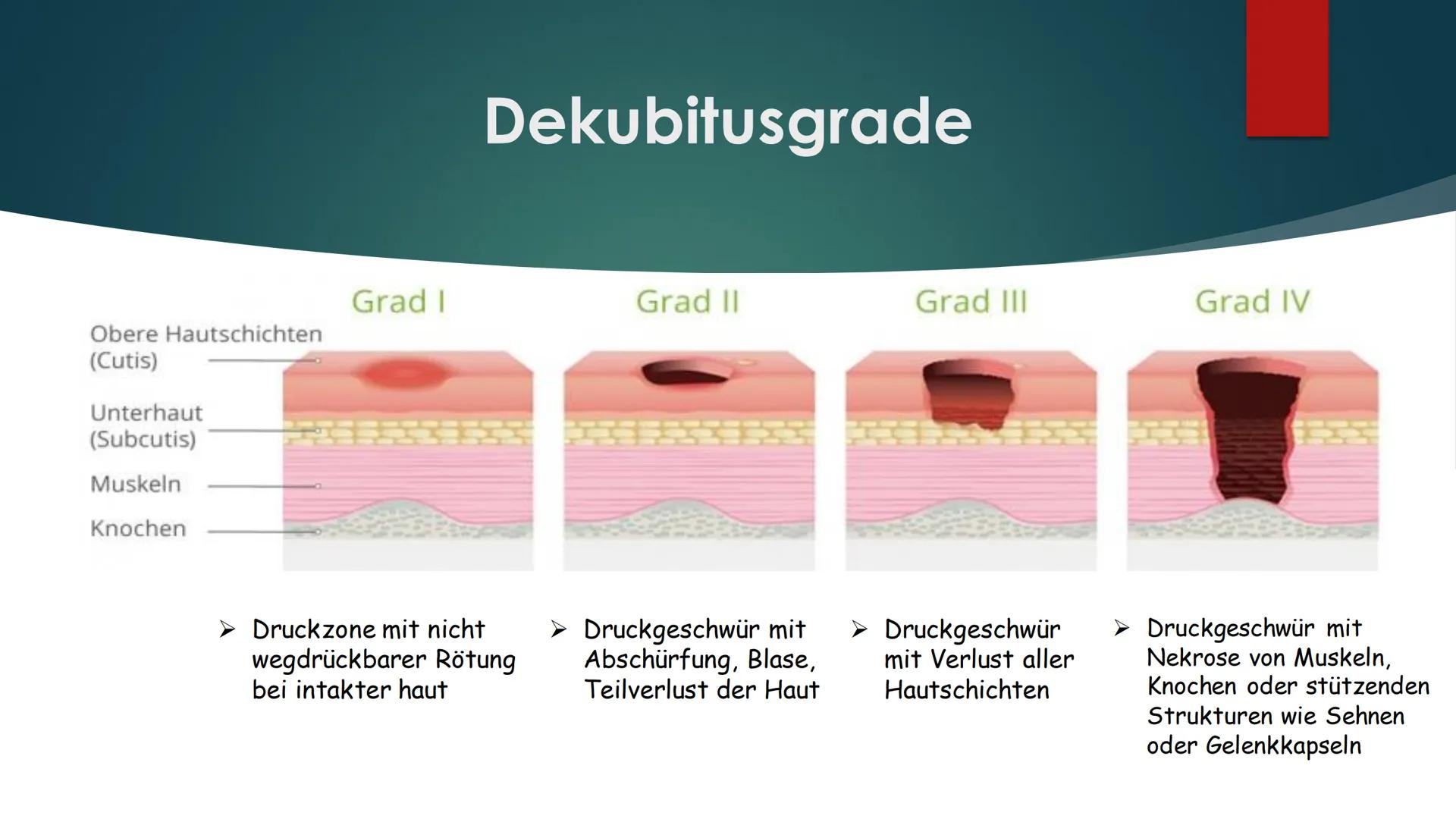 Dekubitus
WAS IST ES?
WIE ENTSTEHT ES? Was ist ein Dekubitus?
> Lokal begrenzte Schädigung der Haut bzw. des darunterliegenden Gewebes
> Med