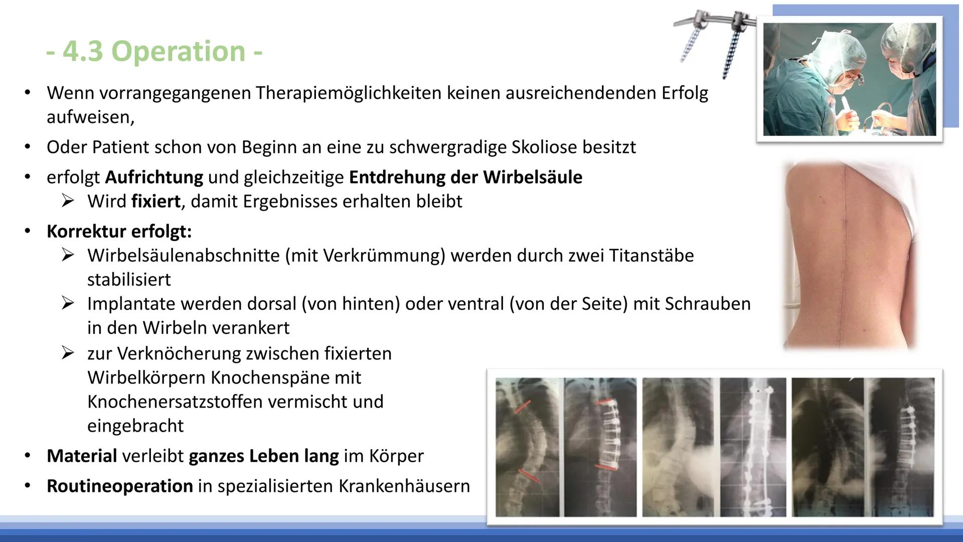 Skoliose -Korsettbehandlung
eine Erfolgsgeschichte? R
BS
1 Begriffsbestimmung
1.1
Definition
1.2 Beschreibung
2 Krankheitsbild
2.1 Ursachen
